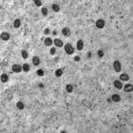 Brasil já tem 140 casos confirmados de Mpox em 2026