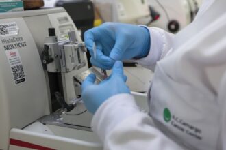 Tratamento inovador corta em 60% risco de morte por câncer de pâncreas
